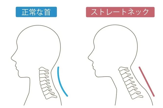 スマホ首(ストレートネック)は危険?原因と1分改善法|上越市...